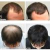2021 Revolutionary Hair Growth Titanium Needle Roller-6236-01