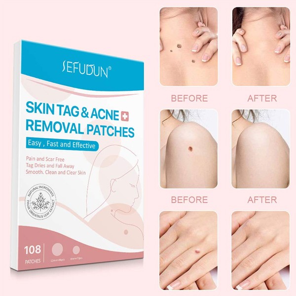 Painless Skin Tags Acne Removal 108Pcs-6916