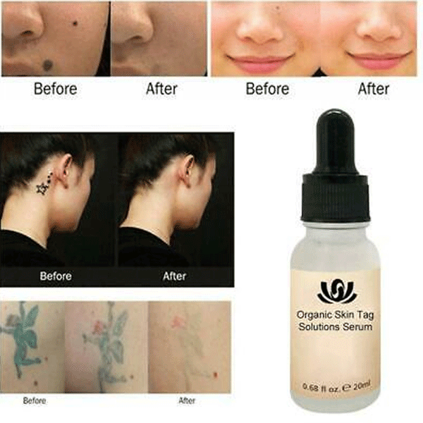 Organic Skin Tags Solutions Serum-9656