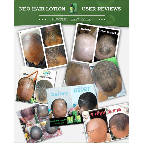Neo Hair Lotion With Titanium Hair Growth Roller-10867